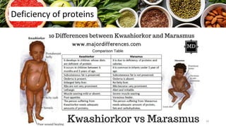 Deficiency of proteins
18
 