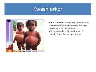Kwashiorkor
Kwashiorkor a deficiency disease with
symptoms of swollen tummies and legs
caused by a lack of protein.
It is caused by a diet with a lot of
carbohydrates but lack of protein.
 