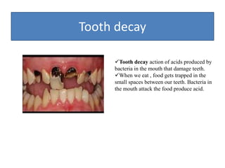Tooth decay
Tooth decay action of acids produced by
bacteria in the mouth that damage teeth.
When we eat , food gets trapped in the
small spaces between our teeth. Bacteria in
the mouth attack the food produce acid.
 