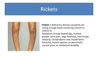 Rickets
Rickets is deficiency disease caused by not
eating enough foods containing calcium or
vitamin D
Symptoms include bowed legs, stunted
growth, bone pain, large forehead, and trouble
sleeping. Complications may include bone
fractures, muscle spasms, an abnormally
curved spine, or intellectual disability
 