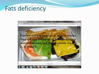 Fats deficiency
 