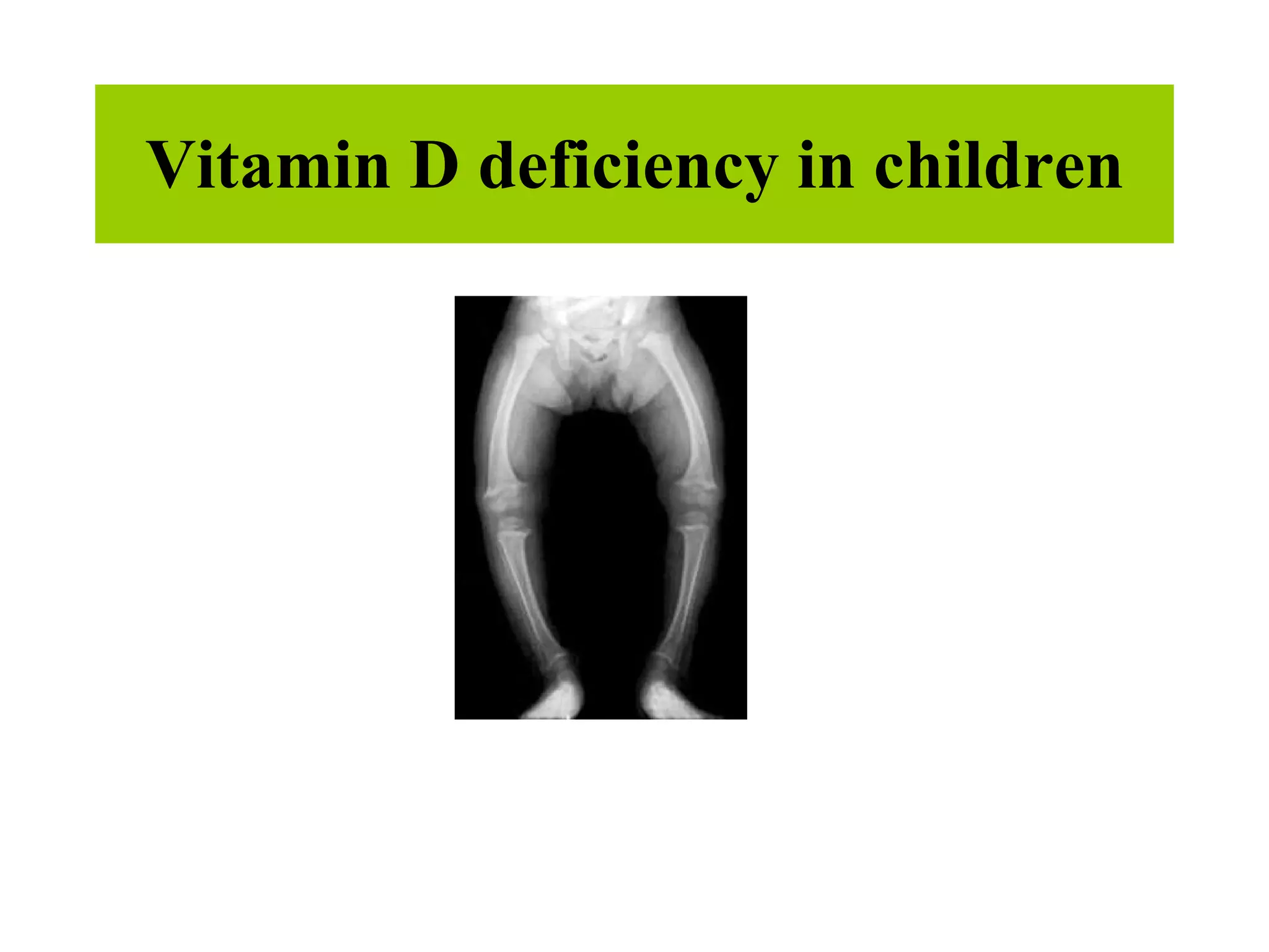 Vitamin D deficiency in children 