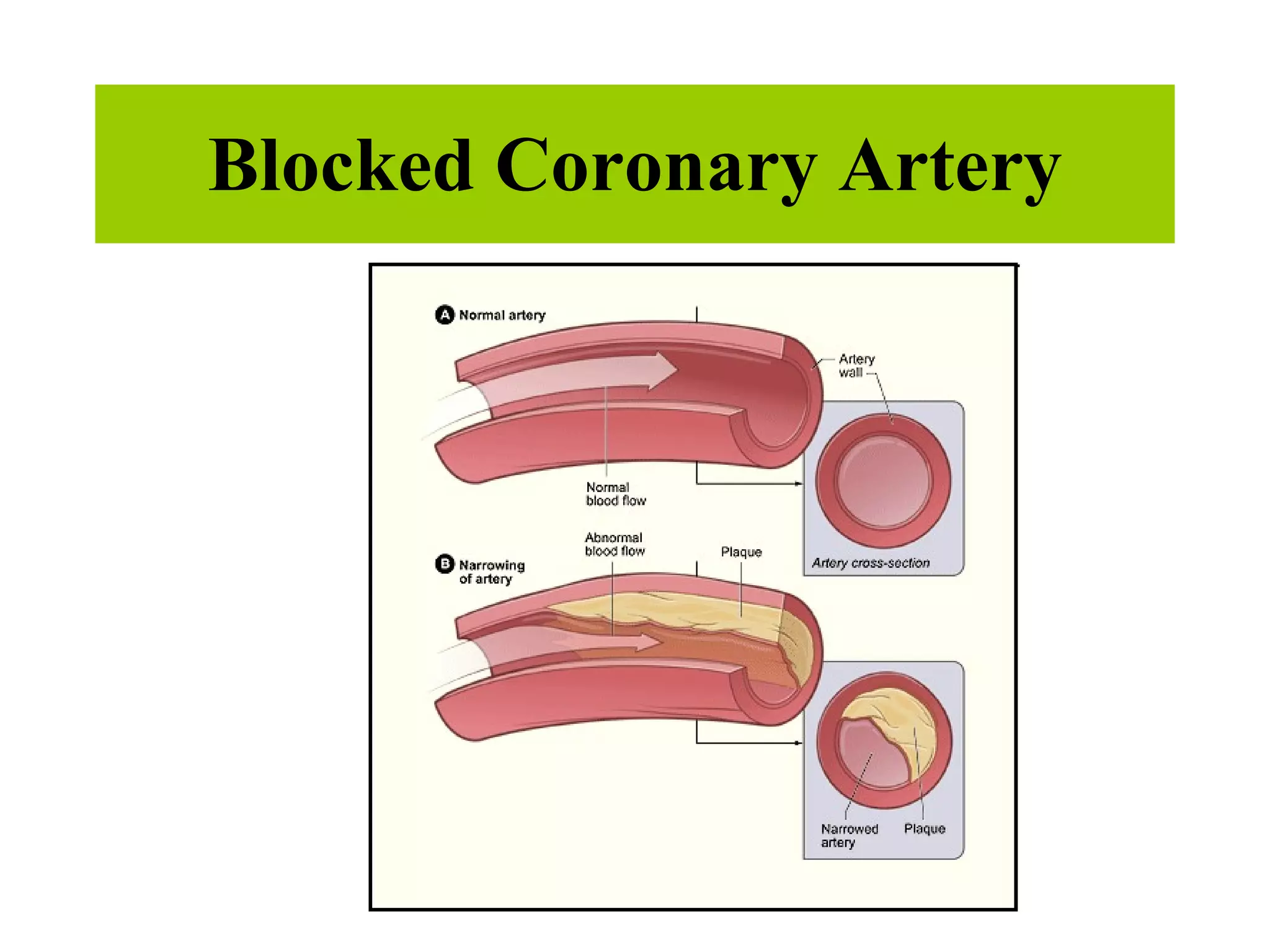 Blocked Coronary Artery 