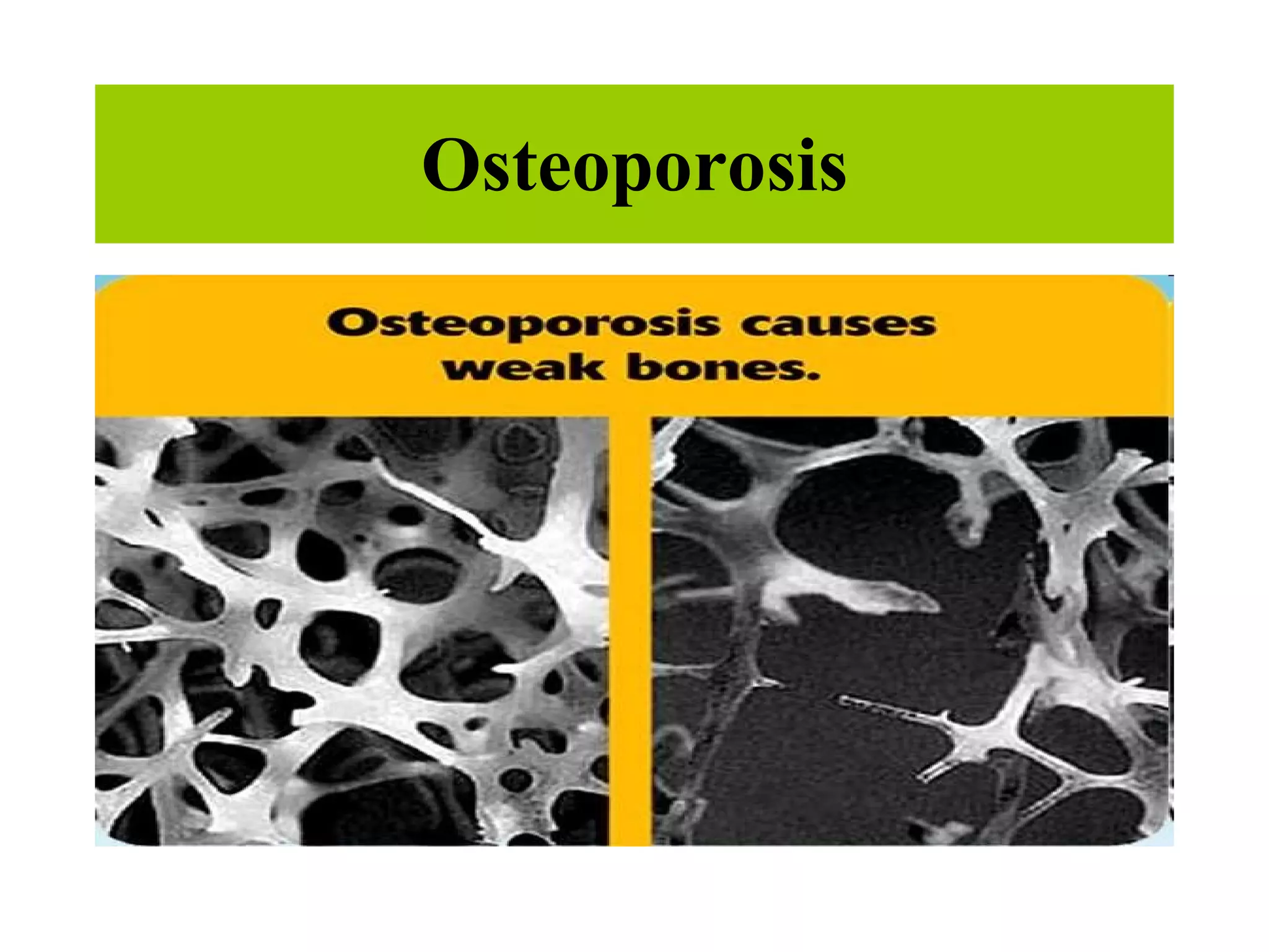Osteoporosis 