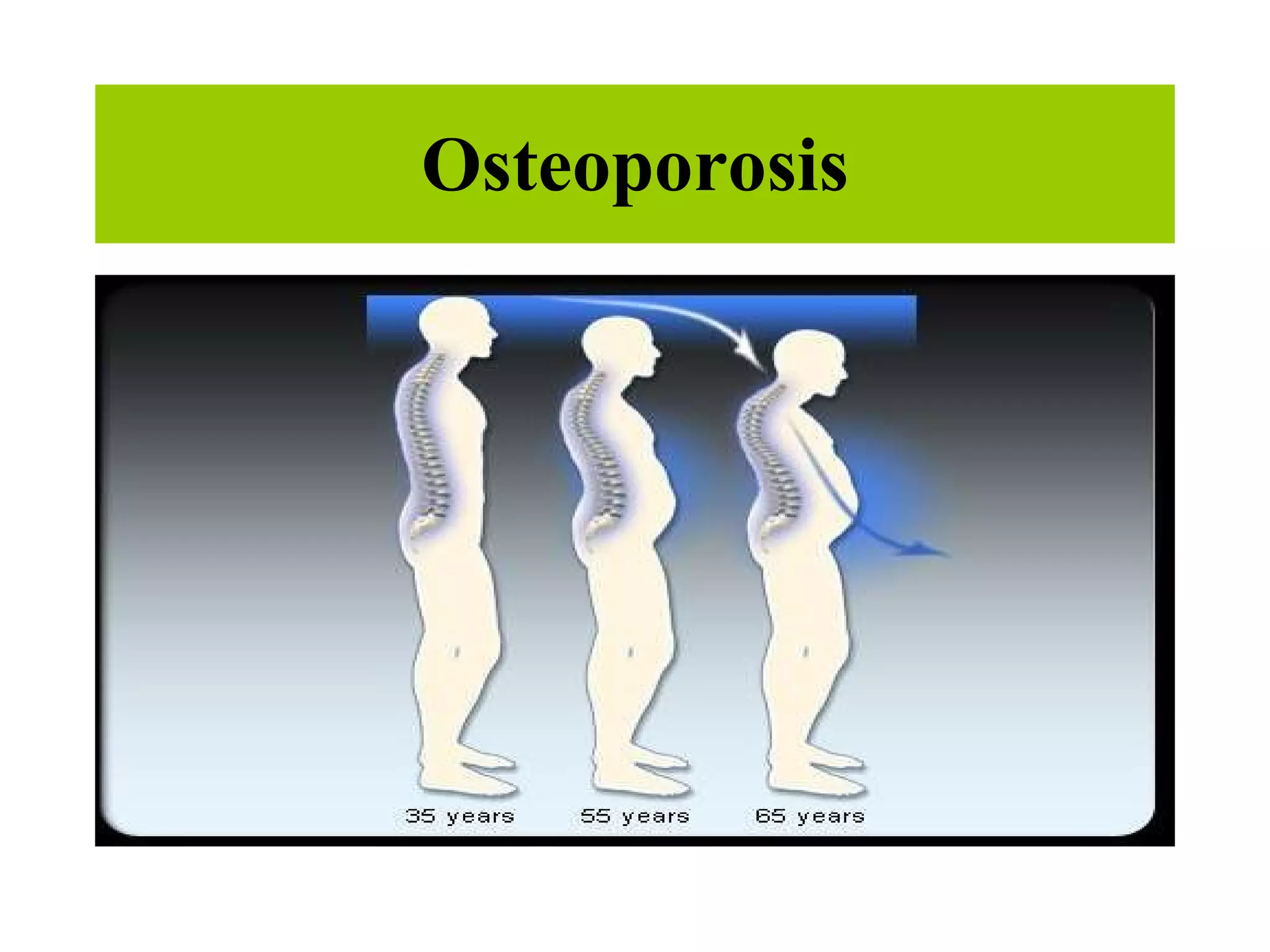 Osteoporosis 