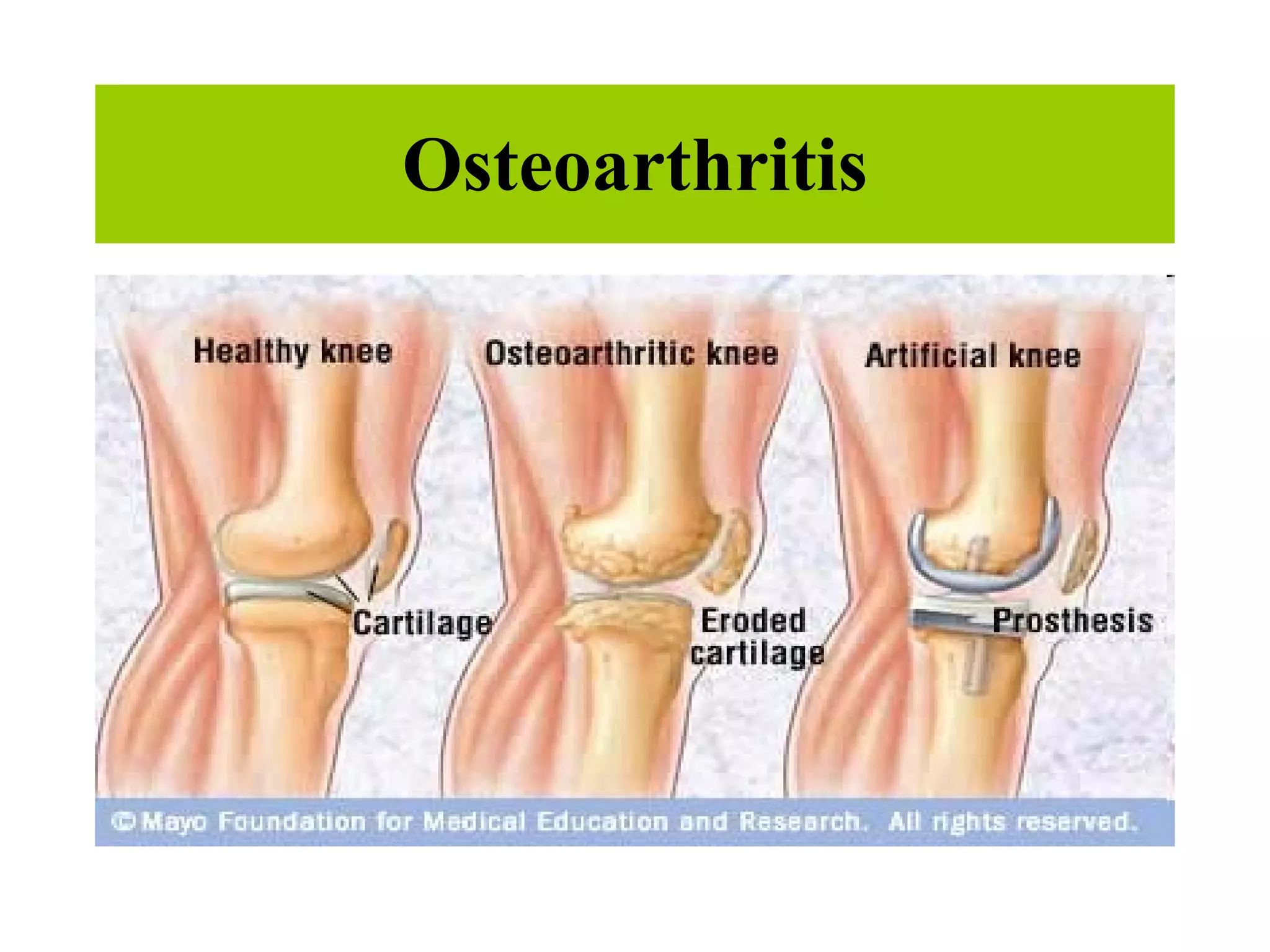 Osteoarthritis 