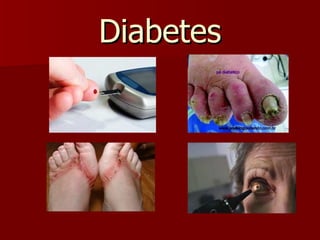 Diabetes 