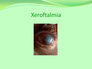 Xeroftalmia

 