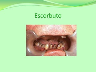 Escorbuto

 