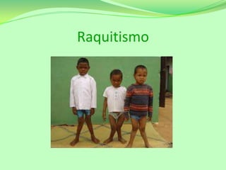 Raquitismo

 