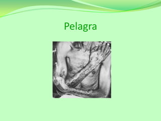 Pelagra

 
