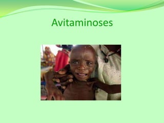 Avitaminoses

 
