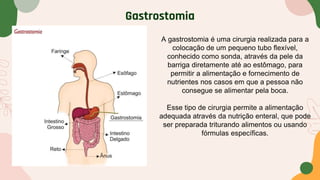 Gastrostomia
A gastrostomia é uma cirurgia realizada para a
colocação de um pequeno tubo flexível,
conhecido como sonda, através da pele da
barriga diretamente até ao estômago, para
permitir a alimentação e fornecimento de
nutrientes nos casos em que a pessoa não
consegue se alimentar pela boca.
Esse tipo de cirurgia permite a alimentação
adequada através da nutrição enteral, que pode
ser preparada triturando alimentos ou usando
fórmulas específicas.
 