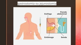 z
gastrostomia ou jejunostomia
 