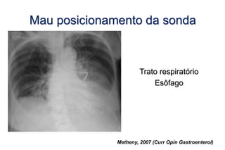 Trato respiratório
Esôfago
Mau posicionamento da sonda
Metheny, 2007 (Curr Opin Gastroenterol)
 
