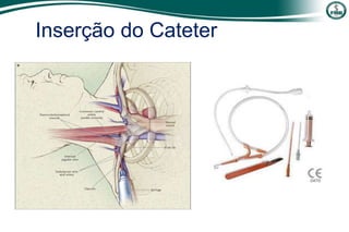Inserção do Cateter
 
