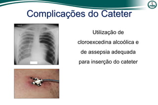 Complicações do Cateter
Utilização de
cloroexcedina alcoólica e
de assepsia adequada
para inserção do cateter
 