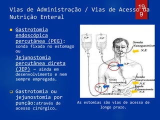 Vias de Administração / Vias de Acesso da
Nutrição Enteral
 Gastrotomia
endoscópica
percutânea (PEG):
sonda fixada no estomago
ou
Jejunostomia
percutânea direta
(JEP) – ainda em
desenvolvimento e nem
sempre empregada.
 Gastrotomia ou
jejunostomia por
punção:através de
acesso cirúrgico.
19
9
As estomias são vias de acesso de
longo prazo.
 