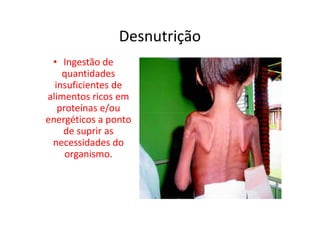 Desnutrição
• Ingestão de
quantidades
insuficientes de
alimentos ricos em
proteínas e/ou
energéticos a ponto
proteínas e/ou
energéticos a ponto
de suprir as
necessidades do
organismo.
 