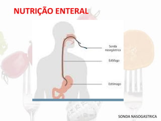 NUTRIÇÃO ENTERAL
SONDA NASOGASTRICA
 