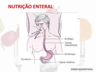 NUTRIÇÃO ENTERAL
SONDA NASOENTERAL
 