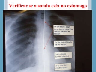 Verificar se a sonda esta no estomago
 
