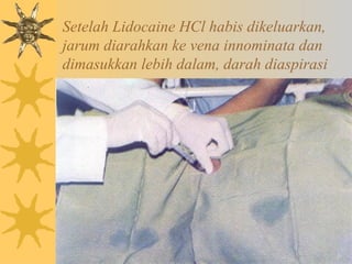Setelah Lidocaine HCl habis dikeluarkan,
jarum diarahkan ke vena innominata dan
dimasukkan lebih dalam, darah diaspirasi
 