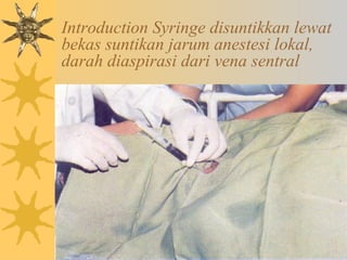 Introduction Syringe disuntikkan lewat
bekas suntikan jarum anestesi lokal,
darah diaspirasi dari vena sentral
 