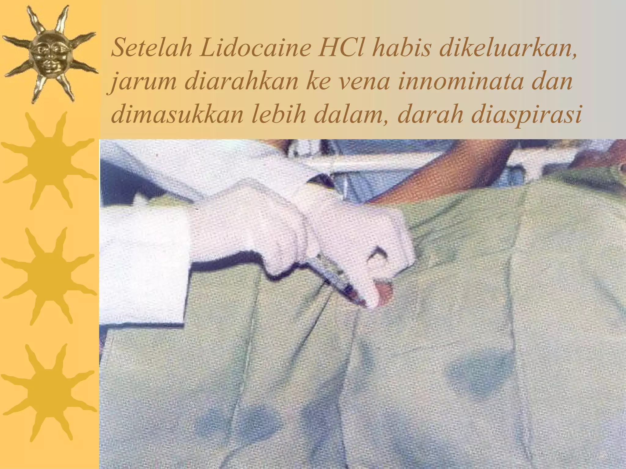 Setelah Lidocaine HCl habis dikeluarkan, 
jarum diarahkan ke vena innominata dan 
dimasukkan lebih dalam, darah diaspirasi 
 