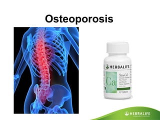 Osteoporosis 