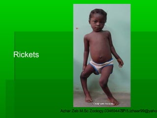 Rickets

Azhar Zeb M.Sc Zoology.03469447715,izhaar99@yahoo
37

 