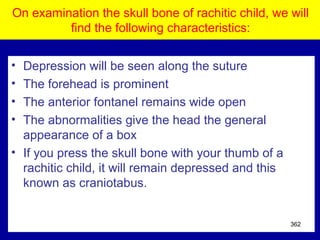 On examination the skull bone of rachitic child, we will
find the following characteristics:
• Depression will be seen along the suture
• The forehead is prominent
• The anterior fontanel remains wide open
• The abnormalities give the head the general
appearance of a box
• If you press the skull bone with your thumb of a
rachitic child, it will remain depressed and this
known as craniotabus.
362
 