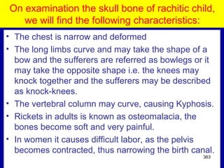 On examination the skull bone of rachitic child,
we will find the following characteristics:
• The chest is narrow and deformed
• The long limbs curve and may take the shape of a
bow and the sufferers are referred as bowlegs or it
may take the opposite shape i.e. the knees may
knock together and the sufferers may be described
as knock-knees.
• The vertebral column may curve, causing Kyphosis.
• Rickets in adults is known as osteomalacia, the
bones become soft and very painful.
• In women it causes difficult labor, as the pelvis
becomes contracted, thus narrowing the birth canal.
363
 