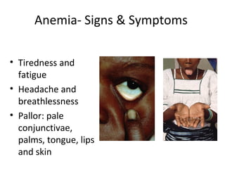Anemia- Signs & Symptoms
• Tiredness and
fatigue
• Headache and
breathlessness
• Pallor: pale
conjunctivae,
palms, tongue, lips
and skin
 