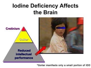 Iodine Deficiency Affects
the Brain
ReducedReduced
intellectualintellectual
performanceperformance
GoiterGoiter
CretinismCretinism
*Goiter manifests only a small portion of IDD
 