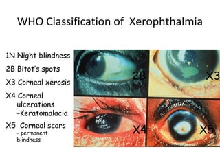 WHO Classification of Xerophthalmia
2B
1N Night blindness
2B Bitot’s spots
X3 Corneal xerosis
X4 Corneal
ulcerations
-Keratomalacia
X5 Corneal scars
- permanent
blindness
X3
X5X4
 