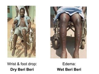 Wrist & foot drop:
Dry Beri Beri
Edema:
Wet Beri Beri
 