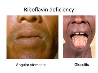 Riboflavin deficiency
Angular stomatitis Glossitis
 