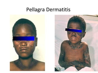 Pellagra Dermatitis
 