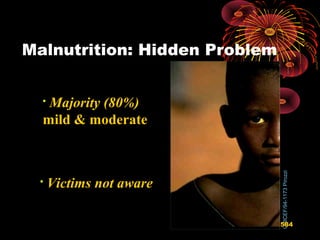 Malnutrition: Hidden Problem
UNICEF/94-1173Pirozzi

Majority (80%)
mild & moderate

Victims not aware
584
 