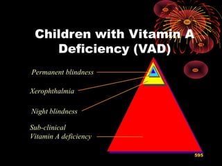Sub-clinical
Vitamin A deficiency
Night blindness
Xerophthalmia
Permanent blindness
Children with Vitamin A
Deficiency (VAD)
595
 
