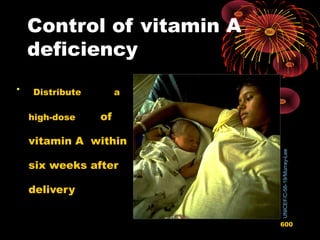 Control of vitamin A
deficiency

Distribute a
high-dose of
vitamin A within
six weeks after
delivery
UNICEF/C-56-19/Murray-Lee
600
 