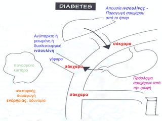 ήπαρ
στομάχι
Παρουσία σακχάρου
στα ούρα
πεινασμένο
κύτταρο
γέφυρα
Ανύπαρκτη ή
μειωμένη ή
δυσλειτουργική
ινσουλίνη
Απουσία ινσουλίνης -
Παραγωγή σακχάρου
από το ήπαρ
Πρόσληψη
σακχάρων από
την τροφή
σάκχαρα
σάκχαρα
σάκχαρα
ανεπαρκής
παραγωγή
ενέργειας, αδυναμία
 