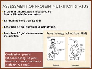 ASSESSMENT OF PROTEIN NUTRITION STATUS
▪ Protein nutrition status is measured by
Serum Albumin Concentration.
▪ It should be more than 3.5 g/dl.
▪ Less than 3.5 g/dl shows mild malnutrition.
▪ Less than 3.0 g/dl shows severe
malnutrition.
Kwashiorkor : protein
deficiency during 1-5 years.
Marasmus : protein deficiency
in infancy (0-1 year).
 
