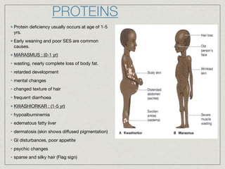 Protein deﬁciency usually occurs at age of 1-5
yrs.

Early weaning and poor SES are common
causes.

MARASMUS : (0-1 yr)

• wasting, nearly complete loss of body fat.

• retarded development

• mental changes

• changed texture of hair

• frequent diarrhoea

KWASHIORKAR : (1-5 yr)

• hypoalbuminemia

• edematous fatty liver

• dermatosis (skin shows diﬀused pigmentation)

• GI disturbances, poor appetite

• psychic changes

• sparse and silky hair (Flag sign)
PROTEINS
 