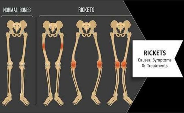 Carrying Ricket Malnutrition | PPT | Bone and Joint Conditions | Diseases and Conditions