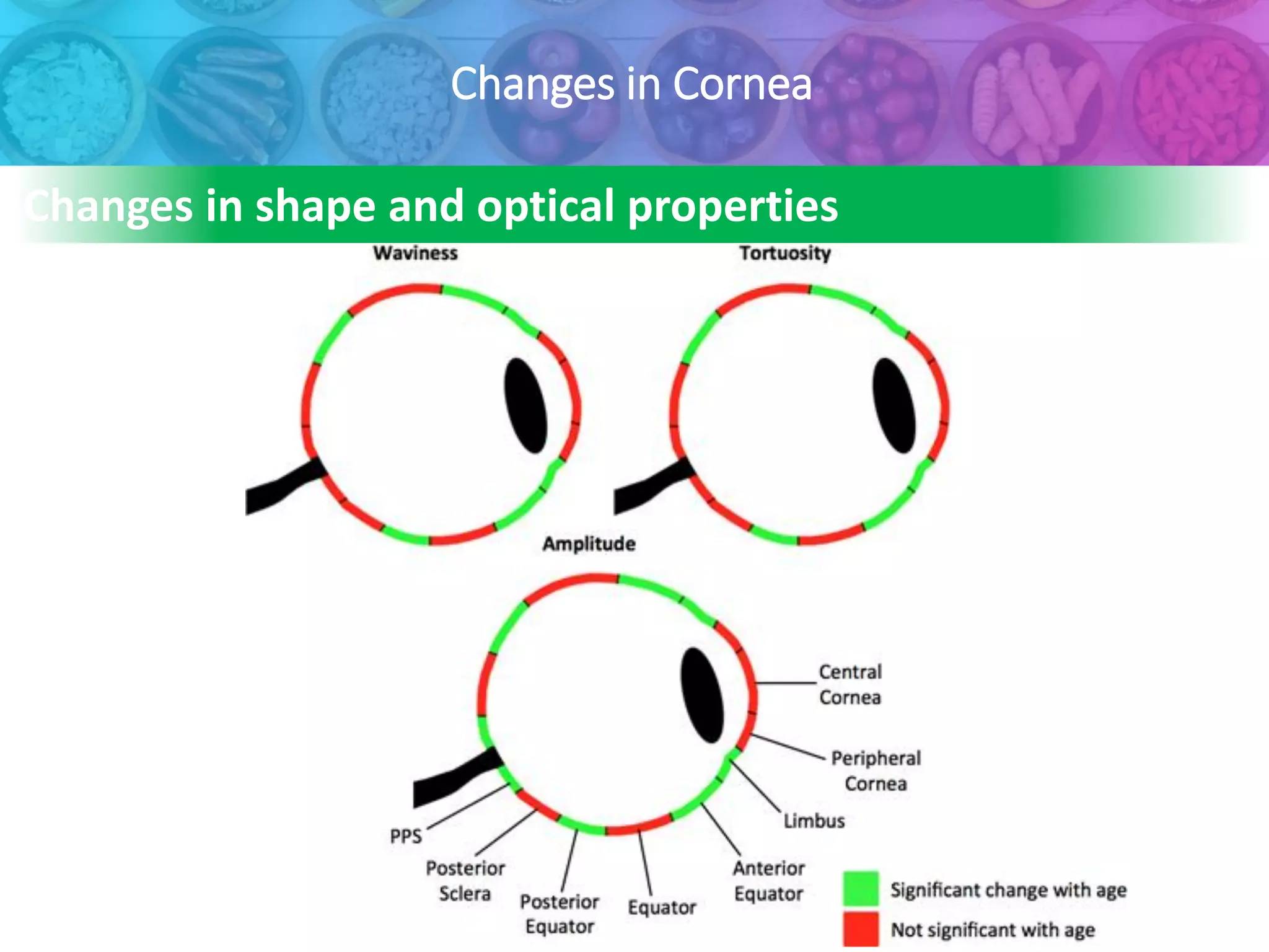 Changes in Cornea
Changes in shape and optical properties
 