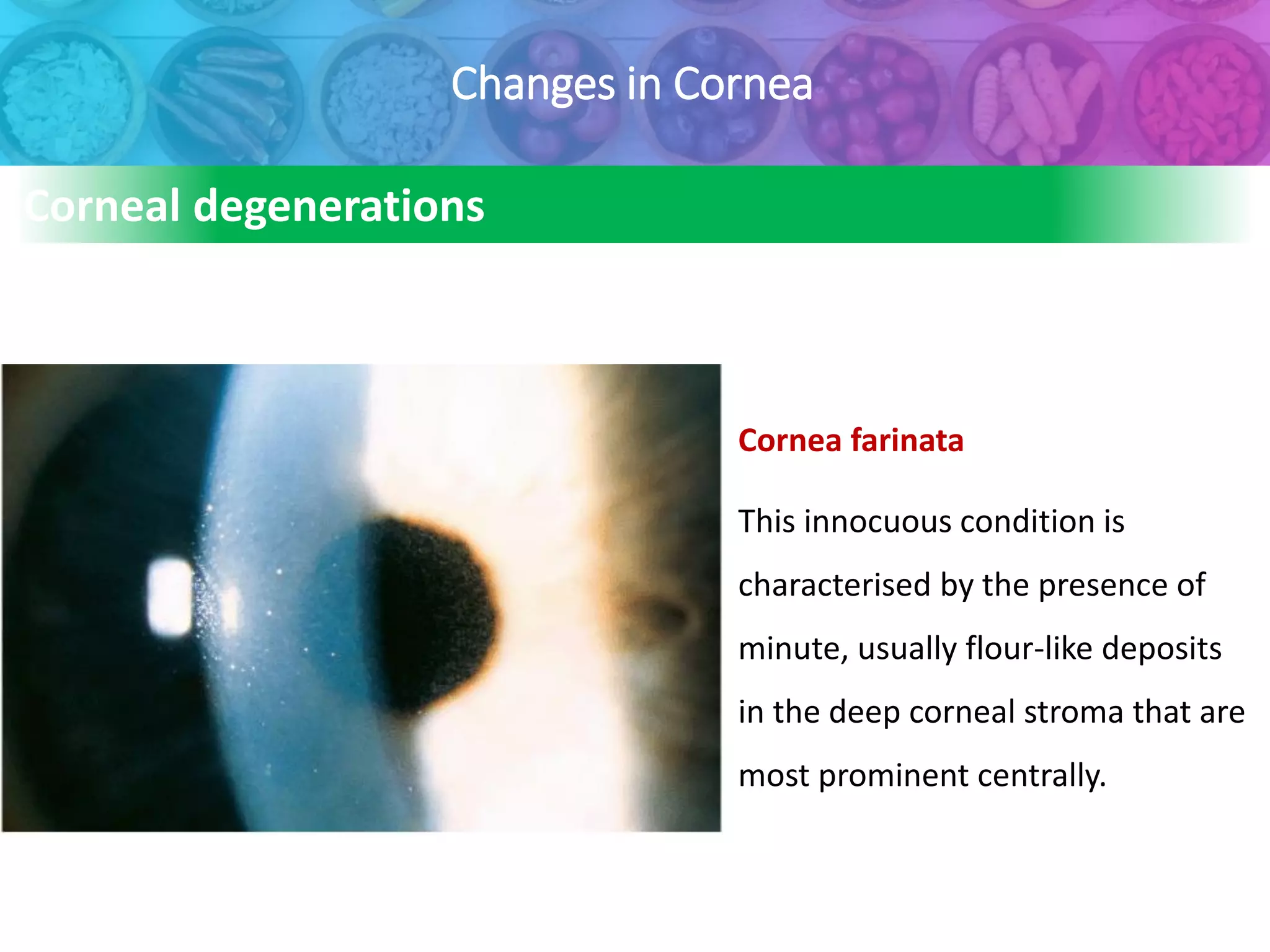 Changes in Cornea
Cornea farinata
This innocuous condition is
characterised by the presence of
minute, usually flour-like deposits
in the deep corneal stroma that are
most prominent centrally.
Corneal degenerations
 
