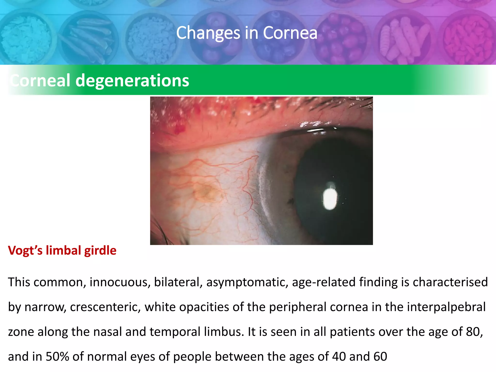 Changes in Cornea
Vogt’s limbal girdle
This common, innocuous, bilateral, asymptomatic, age-related finding is characterised
by narrow, crescenteric, white opacities of the peripheral cornea in the interpalpebral
zone along the nasal and temporal limbus. It is seen in all patients over the age of 80,
and in 50% of normal eyes of people between the ages of 40 and 60
Corneal degenerations
 