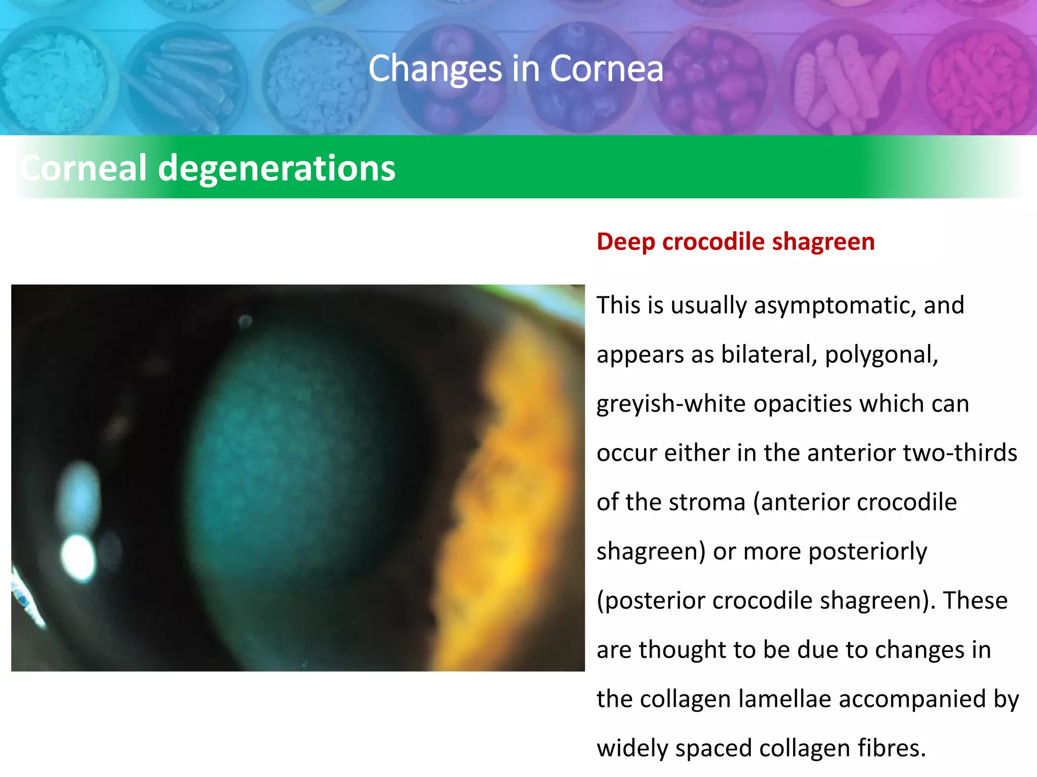 Changes in Cornea
Deep crocodile shagreen
This is usually asymptomatic, and
appears as bilateral, polygonal,
greyish-white opacities which can
occur either in the anterior two-thirds
of the stroma (anterior crocodile
shagreen) or more posteriorly
(posterior crocodile shagreen). These
are thought to be due to changes in
the collagen lamellae accompanied by
widely spaced collagen fibres.
Corneal degenerations
 